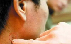 艾滋病前兆是什么,艾滋病早期症状与预防措施